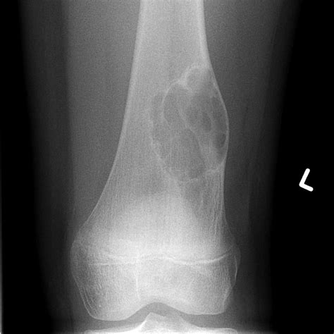 what is non ossifying fibroma