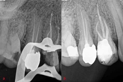 What Is Obturation Of Root Canal