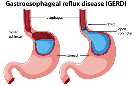 what is oesophageal reflux