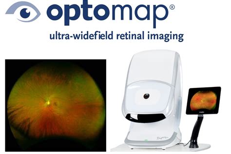 What Is Optomap Imaging
