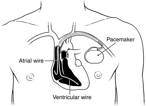 What Is Pacemaker Tracking