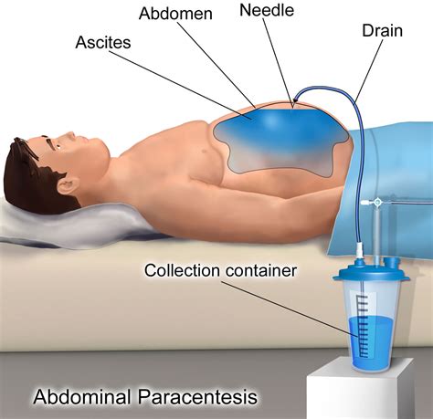 Understanding Abdominal Fluid Drainage: What is Paracentesis and How Does it Help?