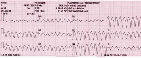 what is paroxysmal supraventricular tac