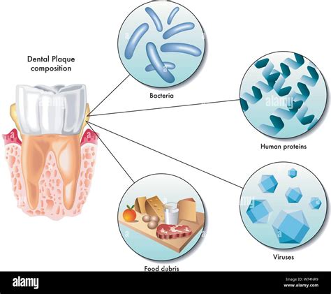 What Is Plaque Bacteria