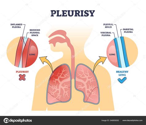 Understanding Pleuritis: What is Pleuritis and How Does it Affect the Body?