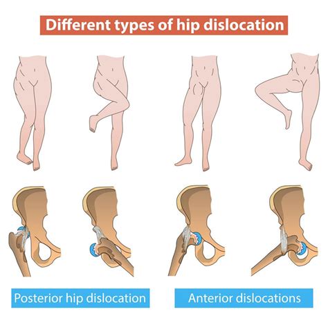 What Is Posterior Hip Dislocation