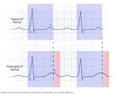 what is prolonged qt syndrome