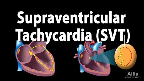 what is psvt heart condition