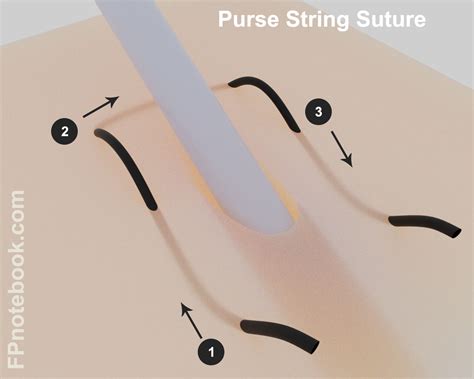 What Is Purse String Suture