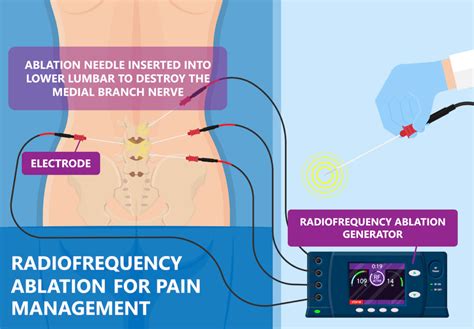 what is radiofrequency ablation