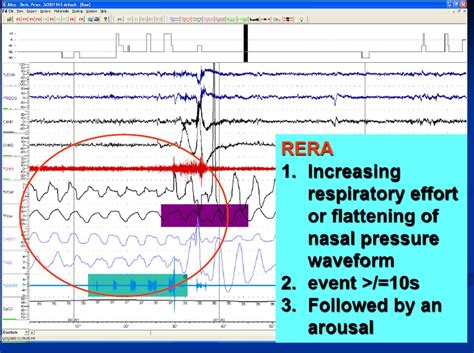 what is rera in cpap