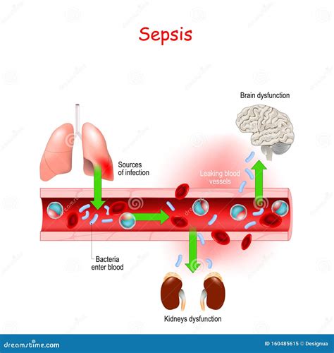 what is sepsis in blood