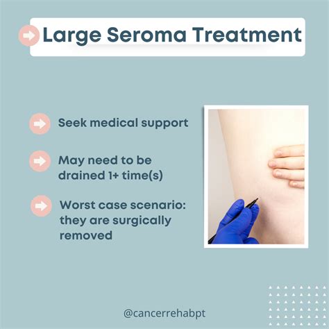 Understanding Fluid Buildup: What is Seroma and How is it Treated?