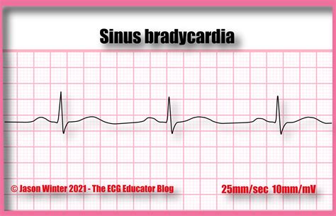 what is sinus bradycardia borderline ecg