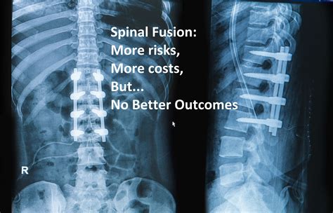 Understanding What is Spinal Fusion: A Comprehensive Guide to the Procedure and Its Benefits