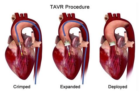 Unlocking the Mystery: What is TAVR and How Does it Revolutionize Heart Health?