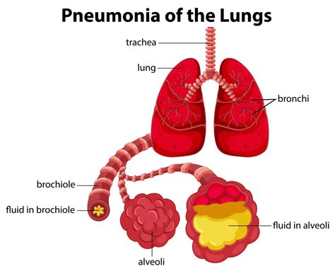 what is the abbreviation for pneumonia