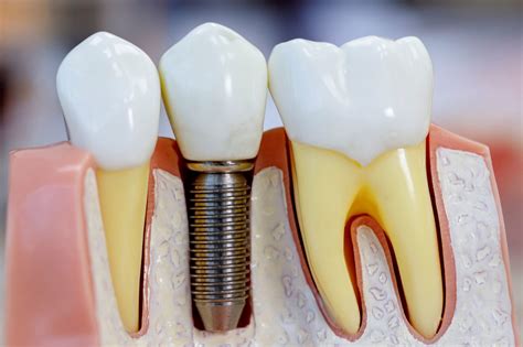 what is the best dental implant procedure