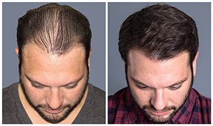 Bosley Hair Restoration Reviews and Cost