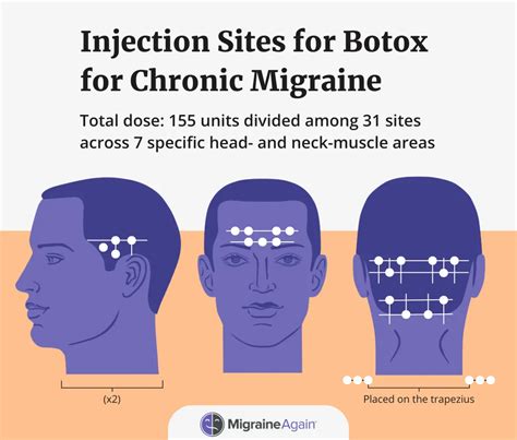 what is the cpt code for botox injections for migraines