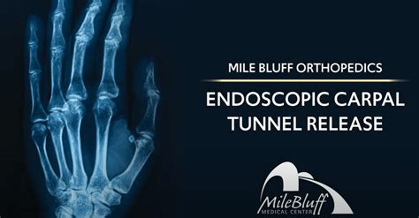 what is the cpt code for endoscopic carpal tunnel release
