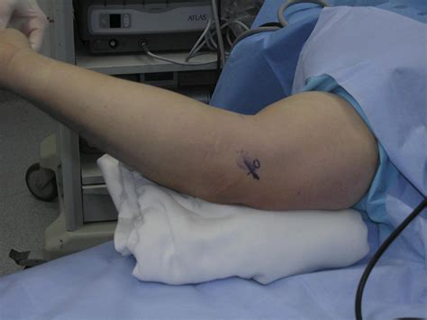 what is the cpt code for endoscopic cubital tunnel release