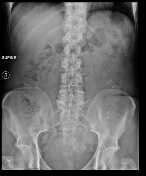 what is the cpt code for sitz marker study