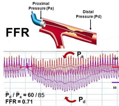 what is the current ffr