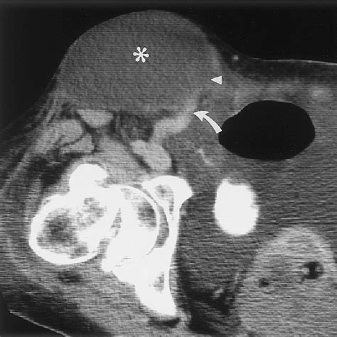 what is the icd for inguinal mass