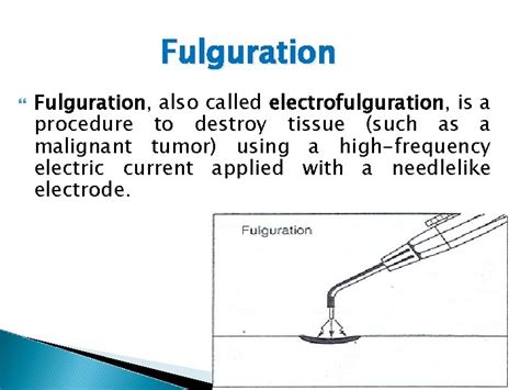 what is the meaning of fulguration quizlet