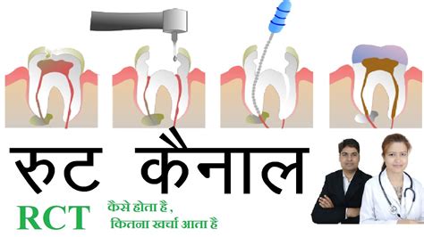 what is the meaning of root canal in hindi