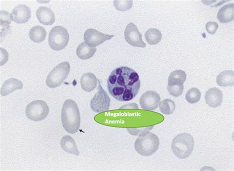 what is the mechanism that causes megaloblastic anemia quizlet