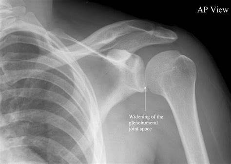 what is the moi for a shoulder dislocation