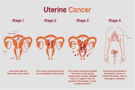 what is the prognosis for endometrial cancer