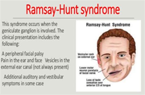 what is the prognosis of ramsay hunt syndrome