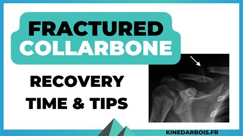 what is the recovery for a broken collarbone