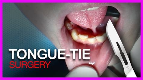 what is tongue tied surgery