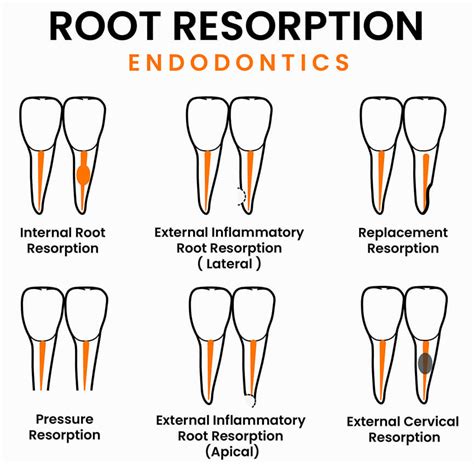 What Is Tooth Root Resorption