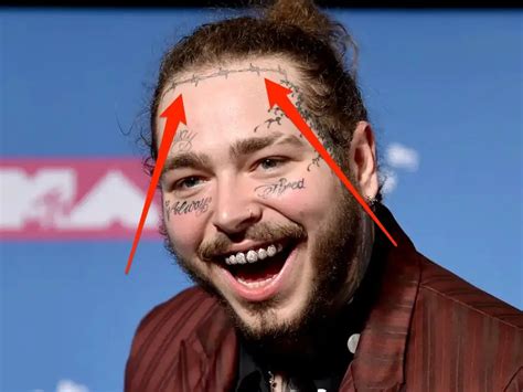 what is up with post malone's teeth