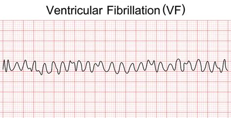 Understanding V Fib: A Life-Threatening Cardiac Emergency Explained