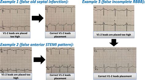 what is v1 and v2 in ecg