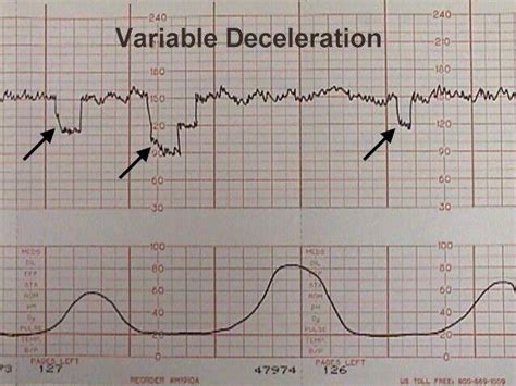what is variable deceleration in ctg