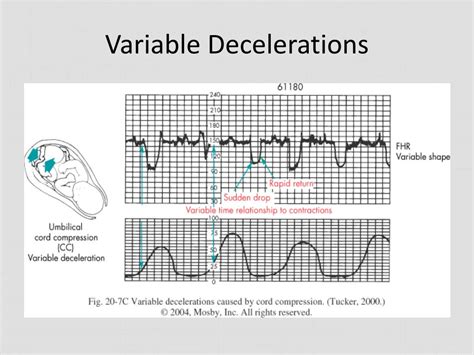 what is variable decelerations in labor