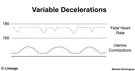 what is variable decels