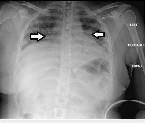 Cureus AntiSignal Recognition Particle AntibodyAssociated Severe