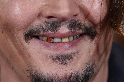 what is wrong with johnny depp's teeth