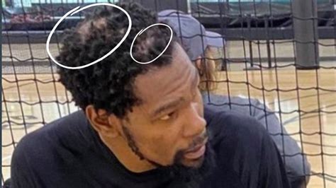 what is wrong with kevin durant's hair