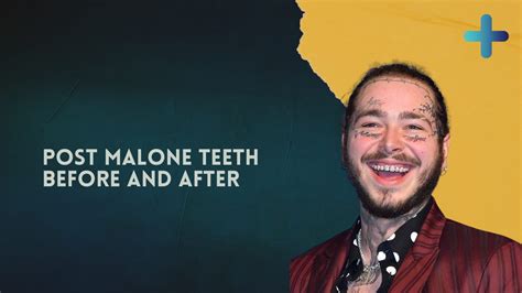 what is wrong with post malone teeth