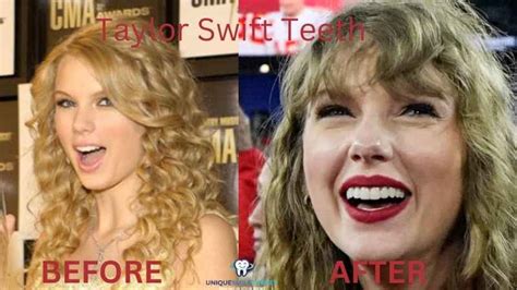 what is wrong with taylor swift's teeth