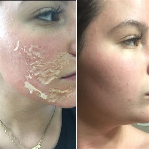Chemical Peel Before & After Chemical peel, Jessner peel, Peeling skin